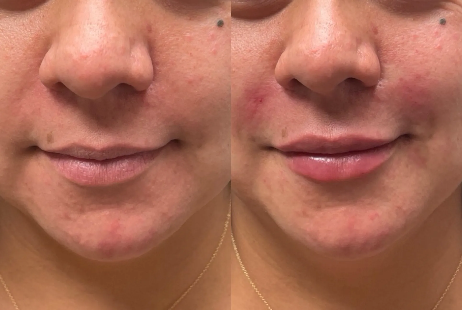 Lip Fillers Park City